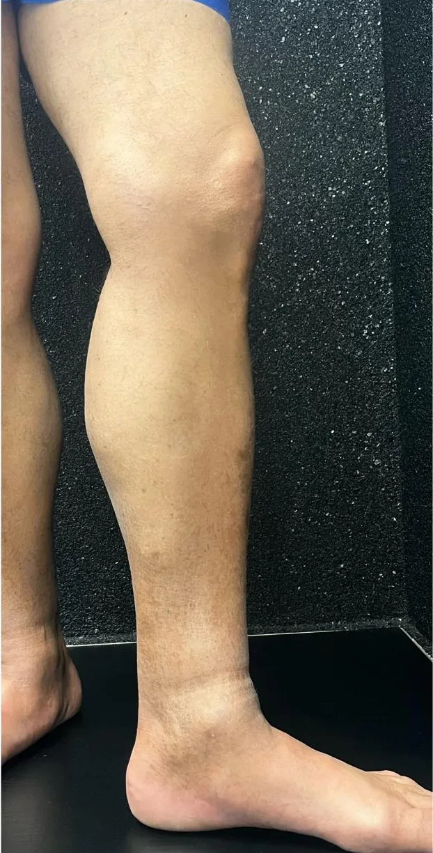 Perna depois do tratamento de varizes